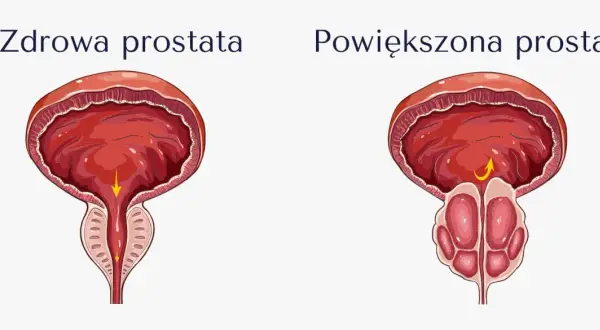 Porównanie zdrowej i powiększonej prostaty. Nowoczesne leki na prostatę pomagają przywrócić prawidłowy przepływ.