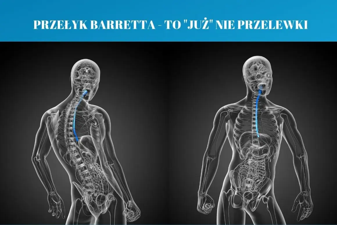 Przełyk Barretta to stan, w którym komórki wyściełające przełyk ulegają zmianom. Grafika pokazuje anatomię przełyku.