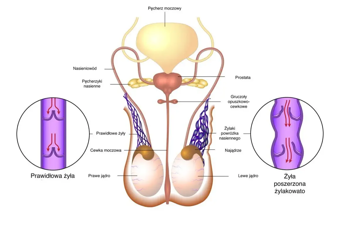 Anatomia męskiego układu rozrodczego. Ilustracja pokazuje jądra, nasieniowody, pęcherz moczowy i prostatę. Po lewej stronie widok prawidłowej żyły, po prawej poszerzonej, co może być związane z nowotworem jądra.