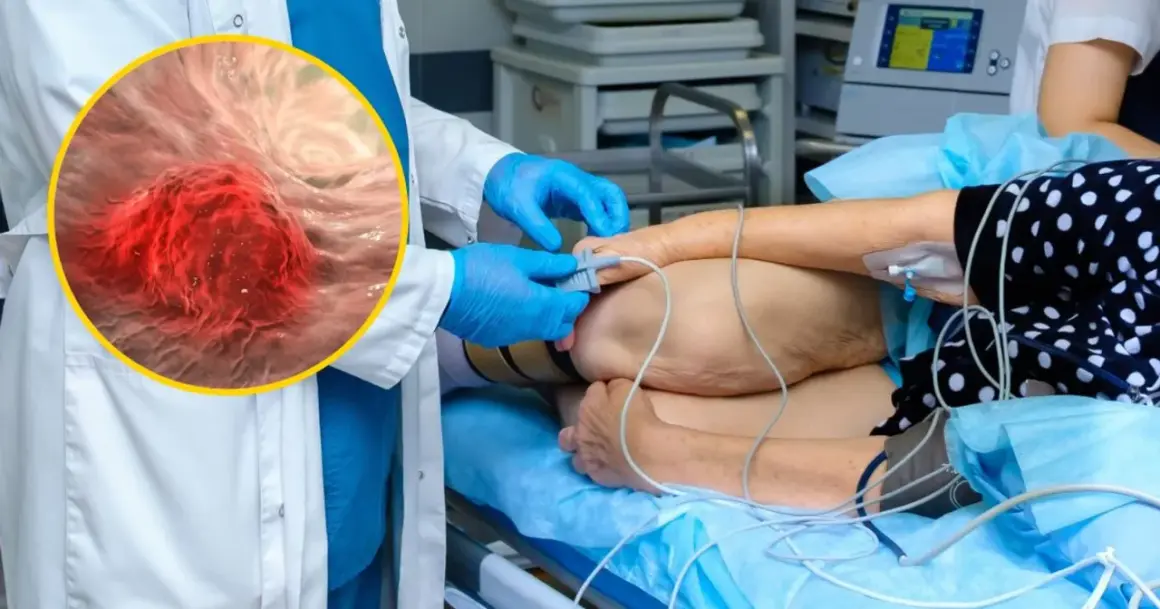 Lekarz w rękawiczkach przygotowuje pacjenta do zabiegu, podczas gdy powiększony obraz pokazuje niebezpieczny gruczolak jelita grubego.