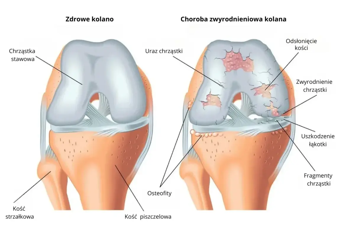 Porównanie zdrowego kolana z kolanem dotkniętym zwyrodnieniami stawów: uszkodzona chrząstka, odsłonięte kości, osteofity.
