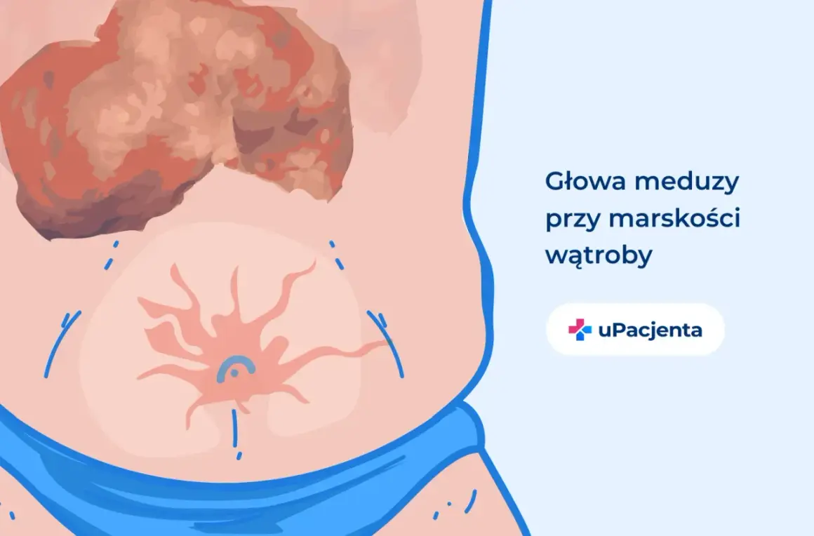 Ilustracja przedstawia brzuch z widoczną, uszkodzoną wątrobą i pajęczakiem naczyniowym. To objawy, które mogą świadczyć o tym, że wyleczyłem marskość wątroby.