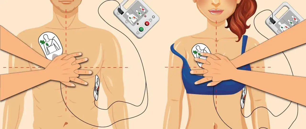 Instrukcja użycia defibrylatora AED: elektrody przyklejone do klatki piersiowej mężczyzny i kobiety, gotowe do akcji bls.