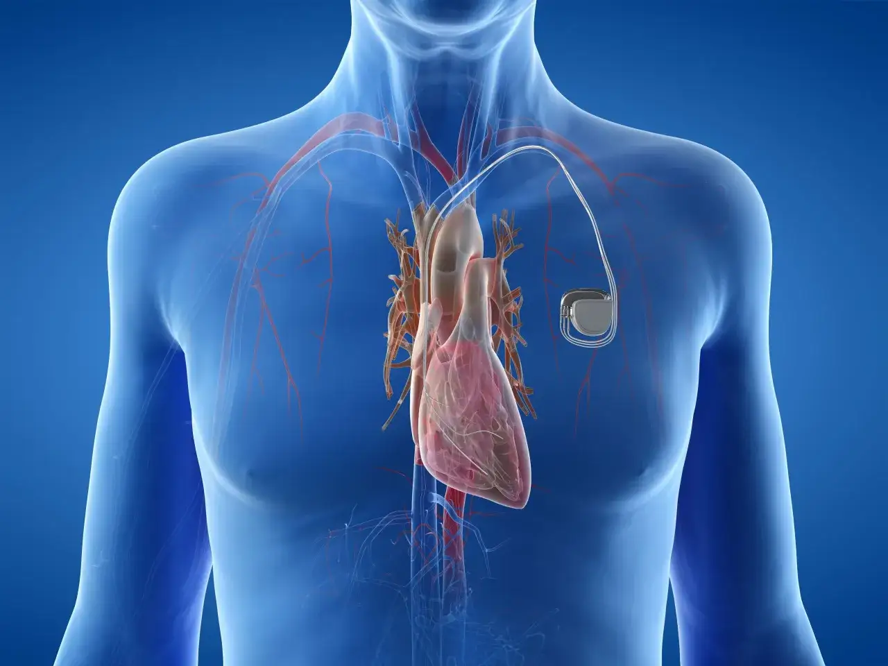 Anatomical illustration showing a human heart with a pacemaker. Zastanawiasz się, ile się czeka na wszczepienie rozrusznika serca?