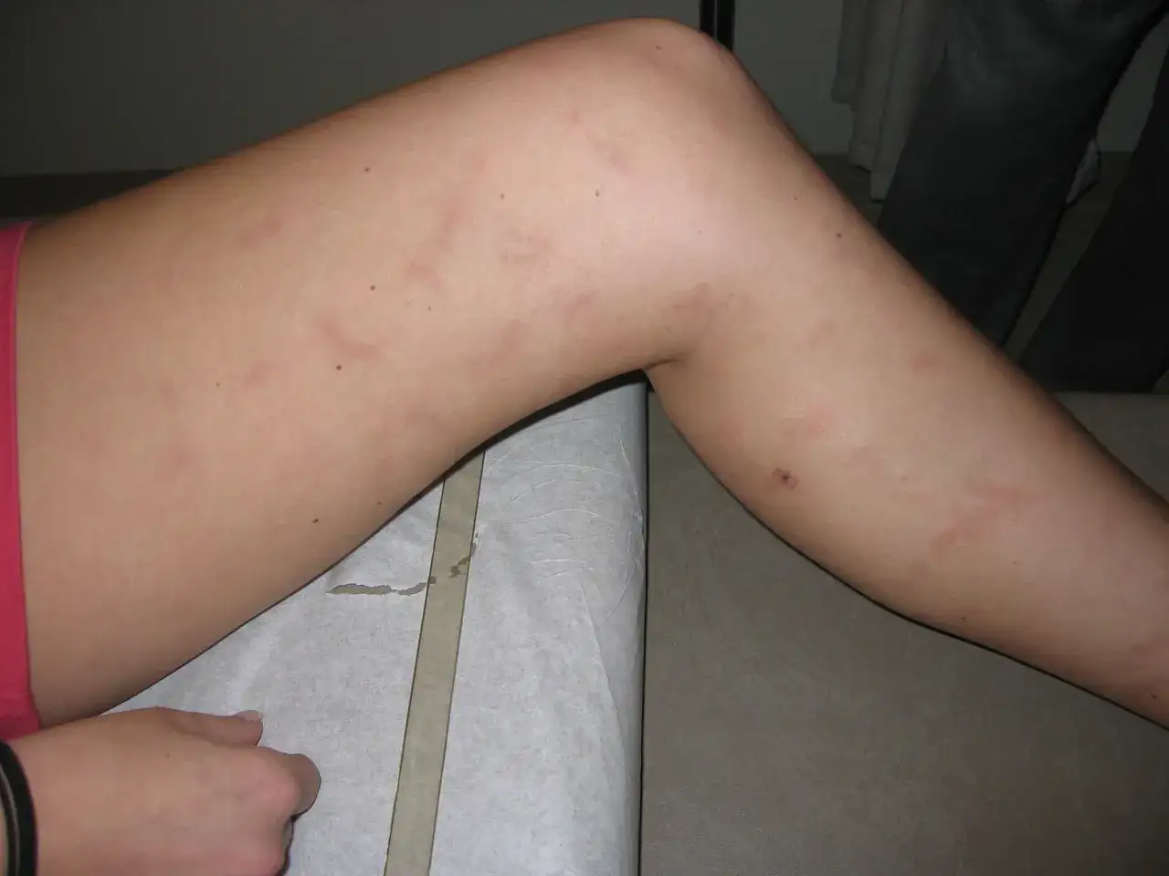 Skóra nogi z zaczerwienieniami i drobnymi krostkami, które mogą być skutkiem ubocznym szczepienia HPV.