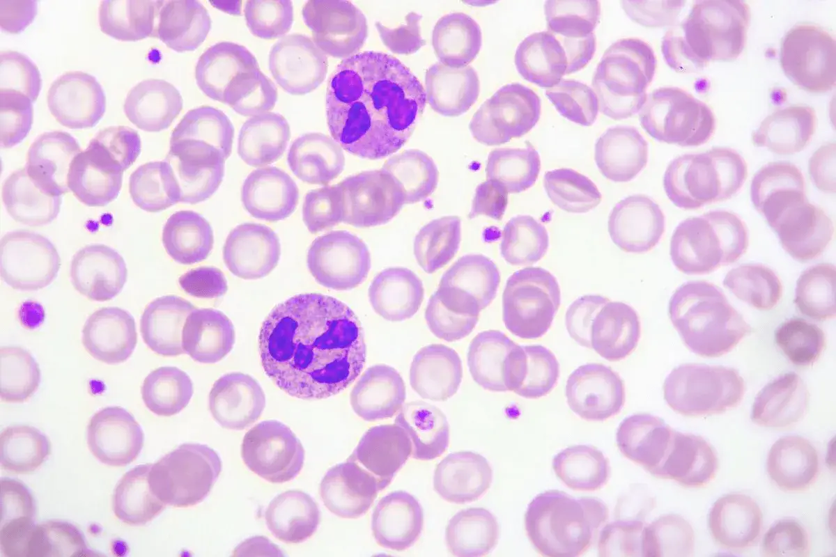 Dwa neutrofile wśród licznych erytrocytów. Obraz może sugerować neutropenię, stan obniżonej liczby neutrofili.