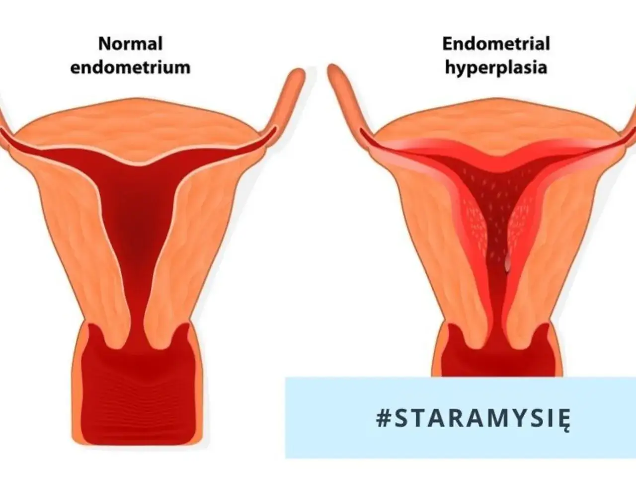 Porównanie prawidłowego endometrium z jego przerostem. Endometrium to błona śluzowa wyściełająca macicę.
