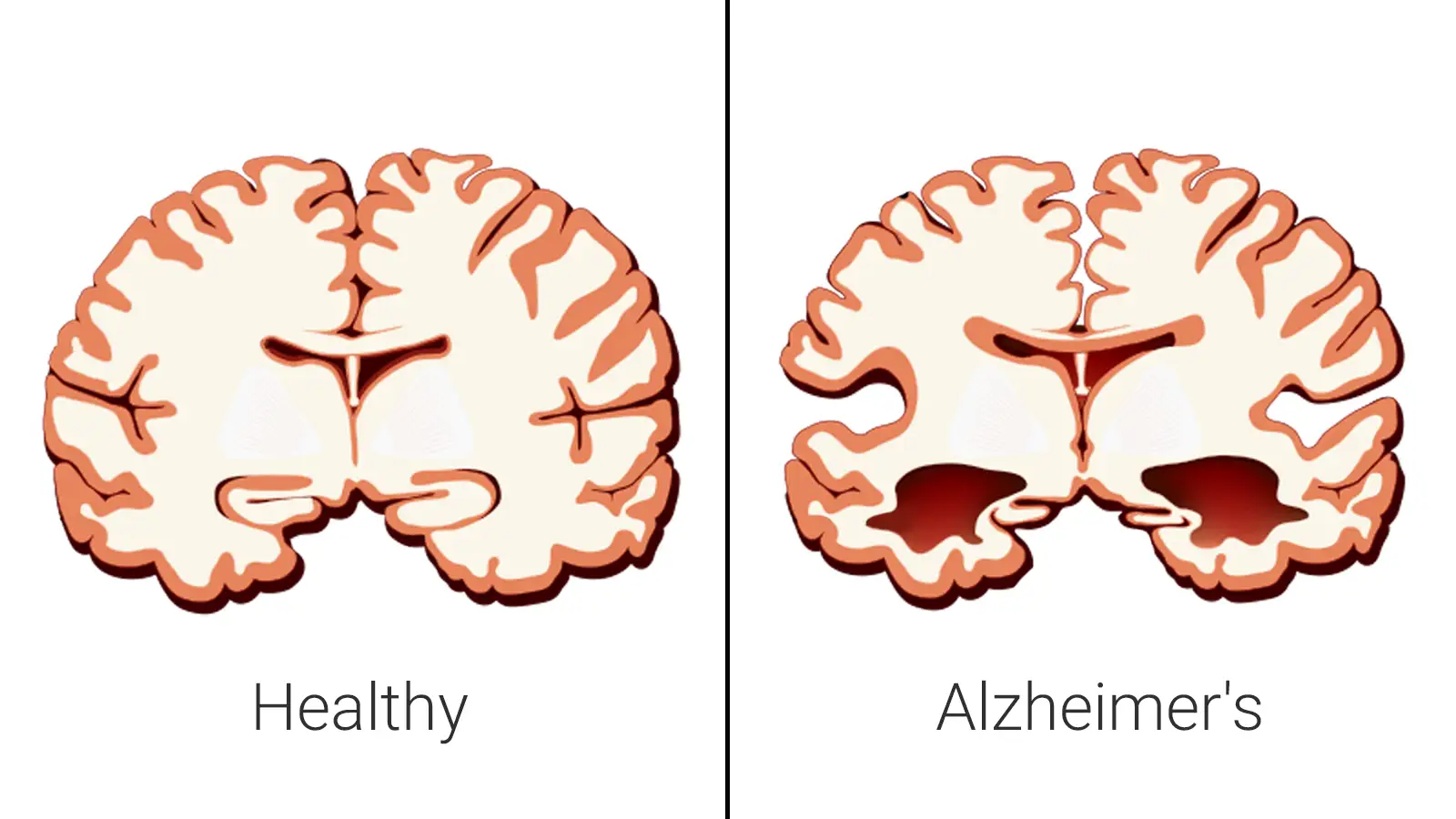 Porównanie mózgu zdrowego i z objawami cukrzycy typu 3 (Alzheimera). Widać zanik tkanki mózgowej.