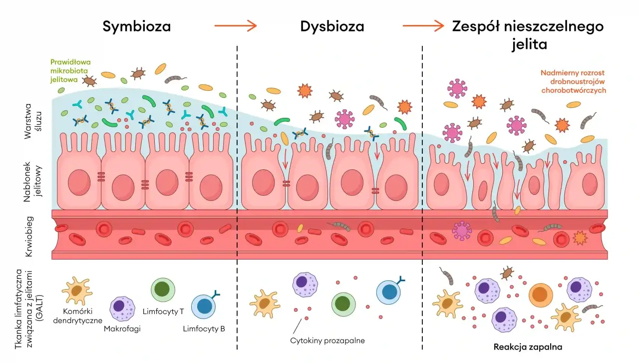 Ilustracja pokazuje przejście od symbiozy do dysbiozy jelitowej, gdzie patogen zwiększa swoją liczbę, prowadząc do stanu zapalnego i nieszczelności jelit.