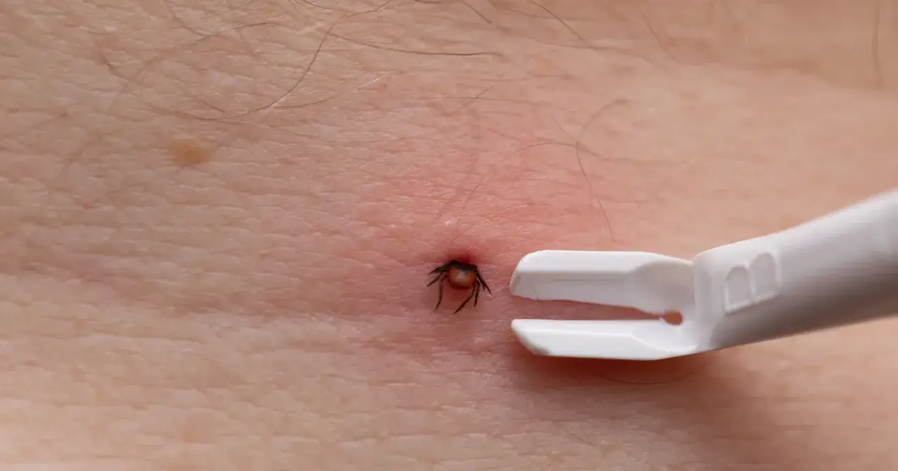 Kleszcz wbity w skórę, obok białe narzędzie do jego usuwania. To ważny krok w profilaktyce boreliozy, podobnie jak szczepienie na boreliozę.