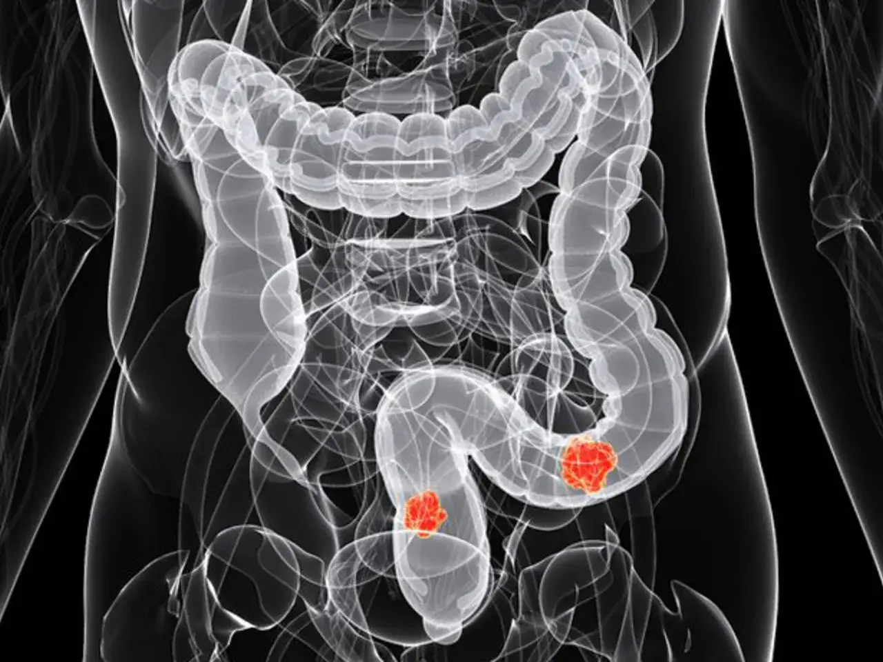 Widok anatomiczny jelita grubego z zaznaczonymi dwoma guzami, wskazującymi na gruczolaka jelita grubego.